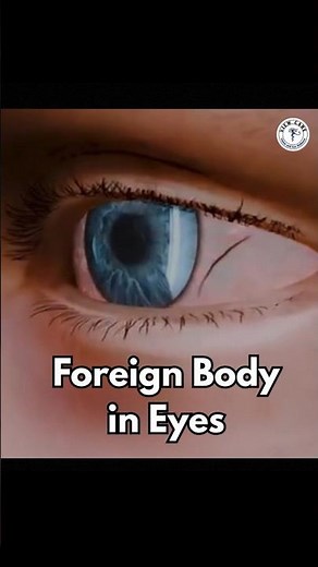 When Eyelashes Harm Your Eyes | Dr. Gaurav Garg Explains
