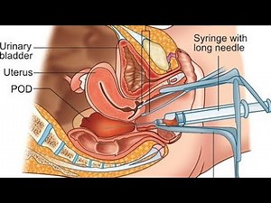 Culdocentesis. Gynecological
