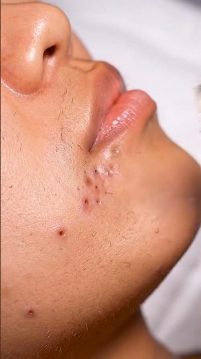 K-Beauty Chin Blackhead ASMR ✨
