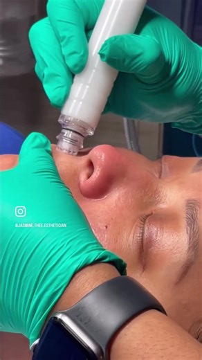 Summer just got a whole lot brighter with SkinWave! Get rid of impurities and give your skin the care it needs this season. SkinWave is an aqua delivery system that exfoliates and brightens while deeply cleansing pores. Get the revitalized, healthy glow you deserve. Book your appointment with Jasmine today and reclaim your summer skin: 1 (469) 521-9579. @nwmeaesthetics * * * * * * * * * * * * * * #esthetician #estheticianlife #aesthetician #estheticians #medicalaesthetics #SkinWave #SummerSkin #