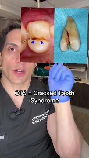 Cracked Tooth Syndrome - What You Should Know