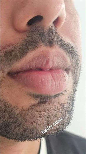 labiaplastie عملية تصغير الشفاه