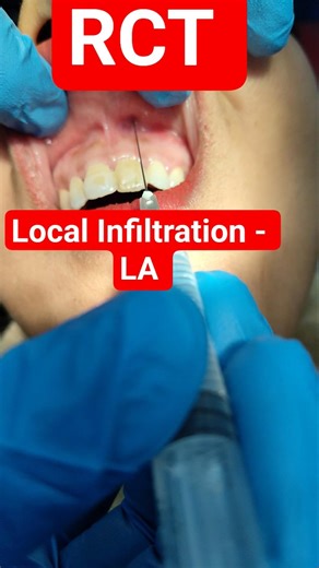 Local Infiltration #Rct #LA #Local Anesthesia #Root canal treatment #dental treatment #dentist