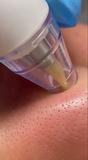 Blackhead Removal Tool Deep Pore Cleansing: How to Get Clear Skin