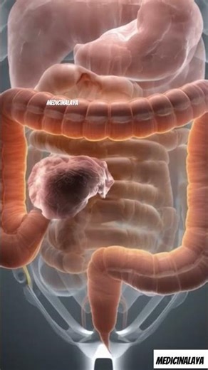 What is COLorectal Cancer?|Cancer #health #shortsfeed #shorts