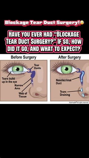 Understanding Blockage Tear Duct Surgery: What to Expect
