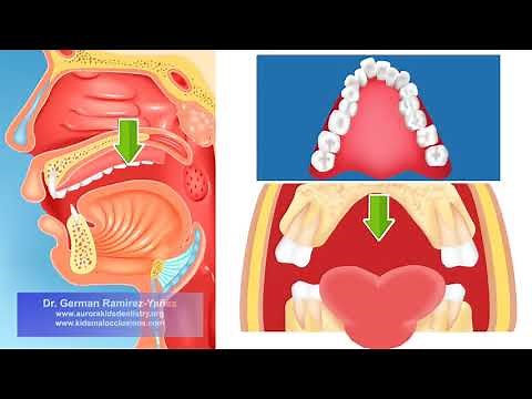 Video Respiracion Bucal by: Dr Germán Ramírez, (Version Español)
