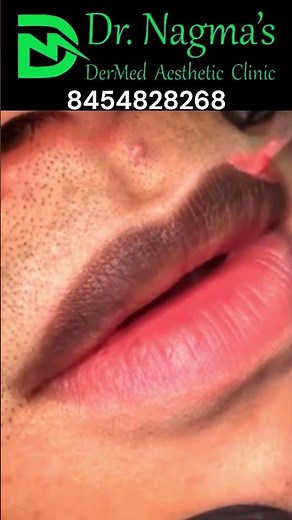 Lip Neutralization or Permanent Makeup for Lips: The Ultimate Guide to a Perfect Pout #lipmakeup