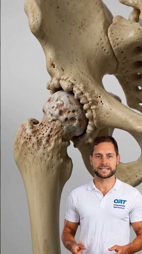Hip Osteoarthritis – 3D Medical Animation