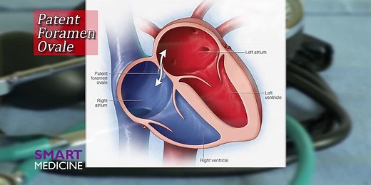 Smart Medicine - Patent foramen ovale