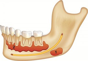 What are some common cysts in oral cavity? - Royal Dental Clinics Blog