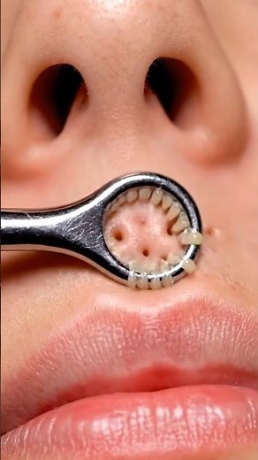 Satisfying Upper Lip Blackhead Extraction with Metal Tool