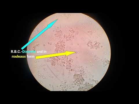 Stool analysis/Lab diagnosis of dysentery/ bacillary dysentery