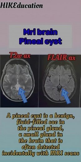 Pineal cyst / mri brain / pineal gland / pineal gland tumor