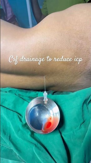 CSF Drainage & ICP Control Prior to Cranioplasty | Neurocritical Care Update