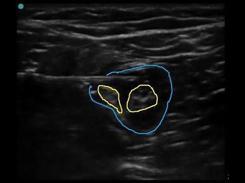 Popliteal block: ultrasound guided classic technique