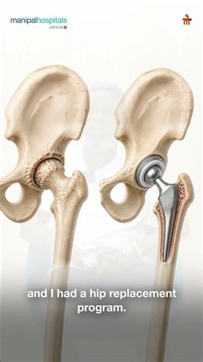 Total Hip Replacement | Dr. Gurdeep Avinash Ratra | Manipal Hospital Gurugram