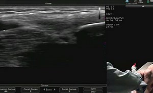 Ultrasound Evaluation of the Knee Pathology, Part 1