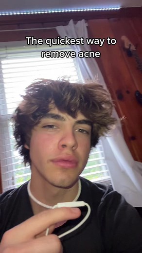 Acne removal hack #dillonlatham | how to get rid of acne