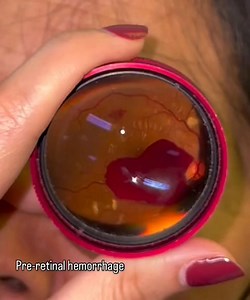 26K views · 469 reactions | Pre-retinal hemorrhage in type 2 DM  Credit to @ophtha_os | OPTOMETRISTS | Facebook