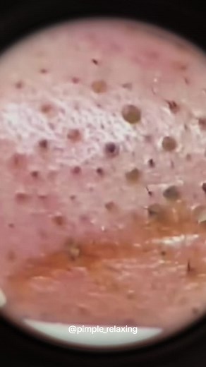 🤤🤤🤤 #blackheads #supersatisfying #extractionsatisfaciton #pimplepop