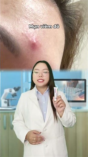 Loại mụn nào nên ưu tiên chấm mụn