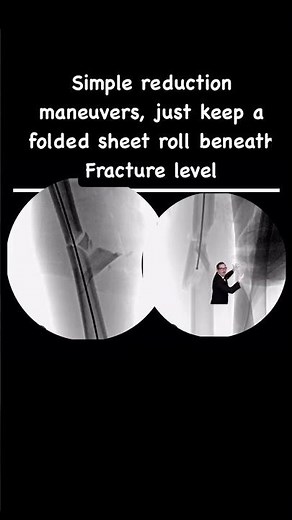 Femur Nailing without Fracture Table