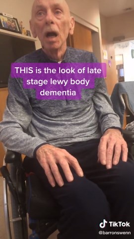Understanding the Stages of Lewy Body Dementia