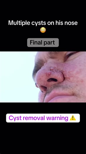 Effective Cyst Removal Techniques for Skin Improvement