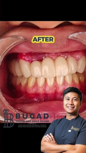From durog na dentures to a confident smile