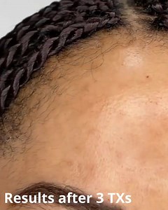 It's #AcneResult weekend - stay tuned for more! "The amazing Neo Elite from Aerolase® is one of our favorite devices in clinic. For this client, we did three sessions of acne treatment with the Aerolase Neo Elite® and combined with one session of a 30% salicylic acid mask." - The Aesthetic Clinic NeoClear by Aerolase® offers patients of all ages and skin types a new safe, effective, and tolerable treatment for acne using advanced 650-microsecond technology. It is a powerful acne treatment that e