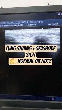 lung sliding and seashore sign on chest ultra. a must know normal phenomenon for a chest sonologist.