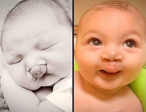 Baby Owen’s parents will never forget the smile he was born with, but they couldn’t be more in love with his new one. Go behind the OR doors as our Cleft Lip and Palate Team performs this life-changing surgery. Speak with our team: http://bit.ly/2k4kFRS | Nationwide Children's Hospital