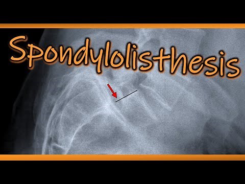 Spondylolisthesis #radiology #anatomy #spine