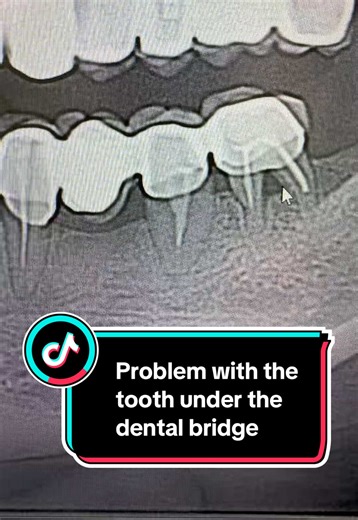 Addressing Tooth Issues Under Dental Bridges
