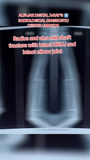 #everyone #tiktokteamunfreezmyacount😥🙏 #tiktokteamviralvideos🙏🙏 #foryoupage❤️❤️ #viralvideo @Ortho Trauma clinic @RadioGrapher🩻🩺🧑‍🎓 @DR.AJMAL.SHAH @Dr Kashif Ali Khan @Dr عبداللہ Jan خٹک @┈━═☆𝙈𝙧. 𝘿𝙄ل𝘿𝘼𝙍☆═━┈ @Dr Imad Ali Khan @Adil shah turangzi 💝🤩 @Am solo @🩻 m Shafiq Radiographer 🩻 @🩺𝐆𝐡𝐚𝐧𝐢 𝐏𝐡𝐚𝐫𝐦𝐚𝐜𝐲