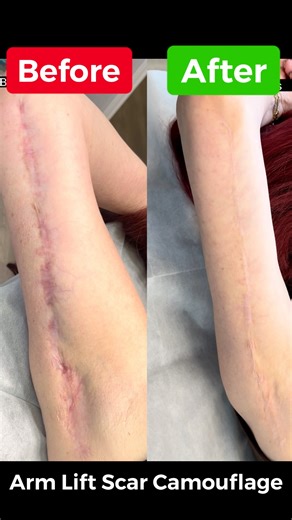 Arm Lift Scar Camouflage | Stunning Before & After