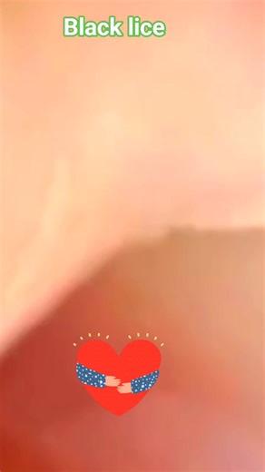 7.6K views · 79 reactions | #lice #kuto #piojos #pulgas #hanoi #removal #vietnam #brasil홸횝회횑횢 횜회횊횕횙 #횔횞횝횘횕횒회횎 #횏횢횙ジ #횝횛횎횗획횒횗횐횛횎횎횕횜 #횖횎횝횊 #횟횒횛횊횕 #횏횢횙횟횒횛횊횕シ #횙횑횒횕횒횙횒횗횎횜 #횝횑횊횒횕횊횗획 #횕횒회횎횙횒회횔횒횗횐 | Srie Yontha | Facebook