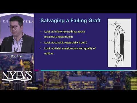 Basic Endovascular Principles in the Management of Femoropopliteal Bypass Graft Disease D K Han