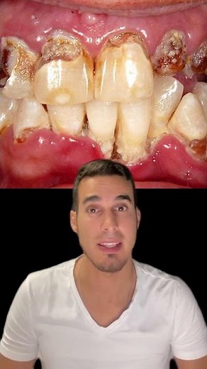METH MOUTH - BOCA DE METANFETAMINA o CRISTAL - Efectos secundarios del abuso de drogas
