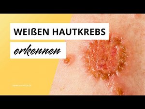 Wie sieht weißer Hautkrebs aus?