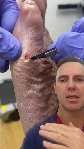 Extreme Ulcer Removal by Skilled Podiatrist with Scalpel #Podiatry #MedicalProcedure
