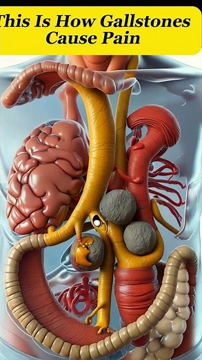 High-detail 3D animation of gallstones blocking bile flow