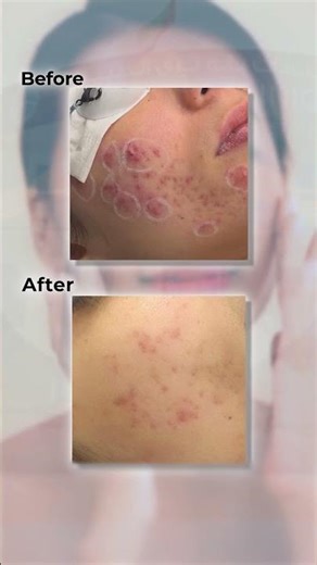 Struggling with Acne? Aerolase Laser Can Change Your Skin in 6 Sessions!