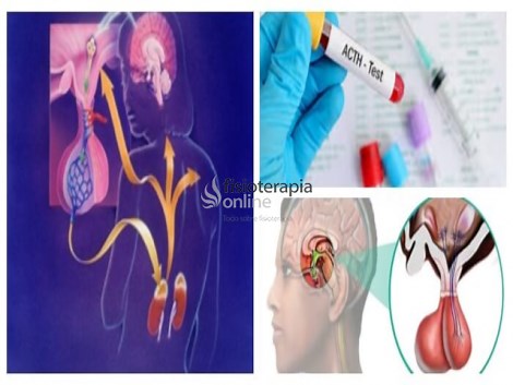 Hormona corticotropina o adrenocorticotropa (ACTH)