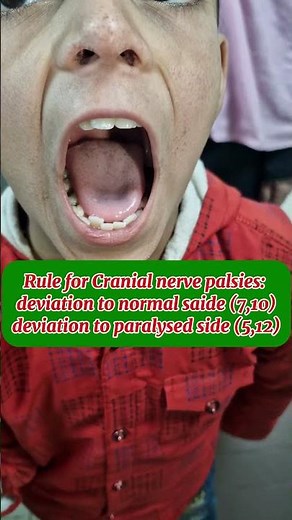 Unilateral palatal palsy | vagus nerve palsy | Unilateral deviation of uvula