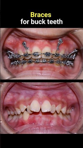 Fix buck teeth with brcaes 36 months #braces #orthodontist #dentist