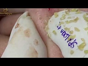 Loan Nguyen Acne Treatment 22z