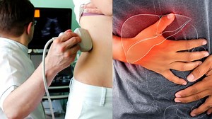 Cáncer de hígado: Así puedes reconocer los síntomas y qué tratamiento llevar