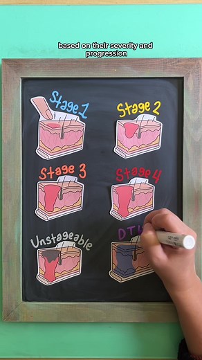 🩹 PRESSURE INJURY STAGES A pressure injury is a breakdown of skin integrity due to unrelieved pressure. There are different stages of pressure injuries that are classified based on their severity and progression. 1️⃣ Stage 1 →Non-blanchable redness →Skin is NOT open but appears swollen and irritated 2️⃣ Stage 2 →Skin NOT intact →Shallow, open ulcer with partial thickness skin loss →NO fat or muscle exposed 3️⃣ Stage 3 →Full thickness skin loss →Subcutaneous fat visible →NO exposed bone, muscle,